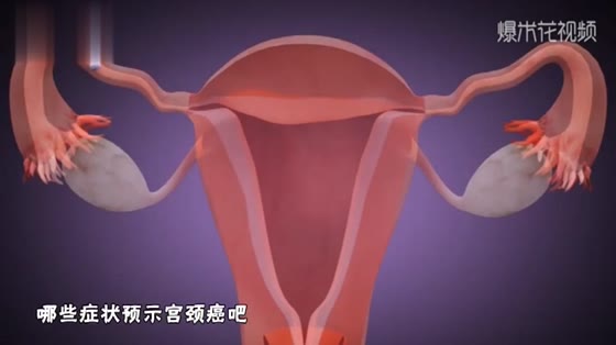 A 20-year-old single girl suffers from cervical cancer, which originally appeared on her underwear.