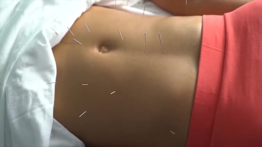 Beautiful white-collar workers work hard and become sick. Where does the whole body ache? Acupuncture and moxibustion in traditional Chinese medicine has pricked her into a hedgehog.