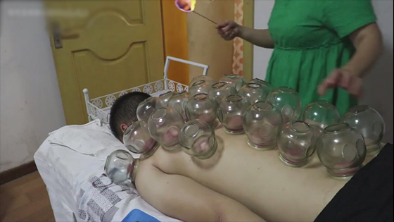 Chinese massage: cupping glass experience, do you want to have a try?