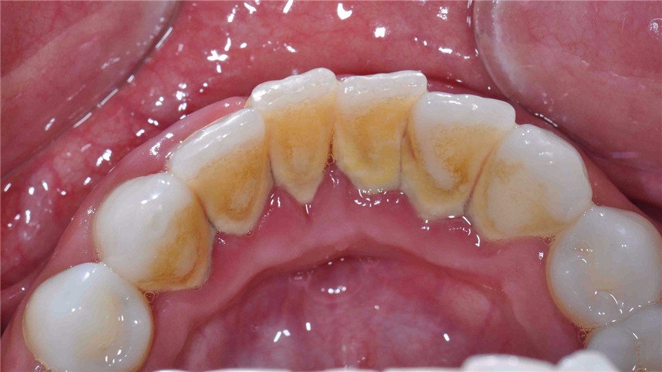 Why do some people have a thick layer of yellow mud on their teeth? What exactly is it?