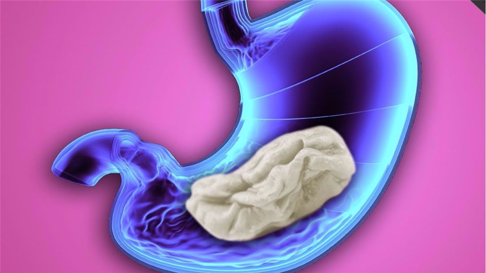 What happens when you swallow gum in your stomach? Does it stick to your intestines?