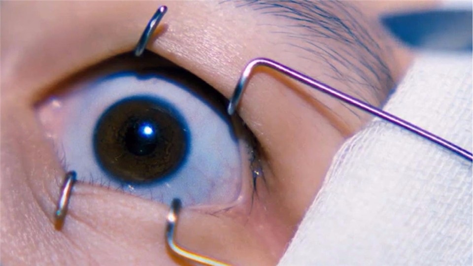 How many people can donate a cornea? Ophthalmologist tells the truth