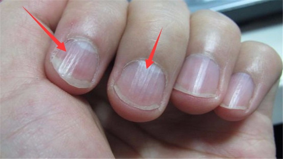 What happened to the strange vertical lines on the nails? Originally, the body was transmitting a distress signal.